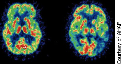 Picture of a normally functioning brain compared to an alzheimer's brain.
